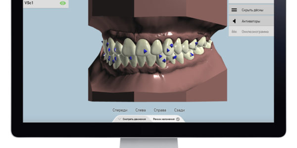 Элайнеры StarSmile